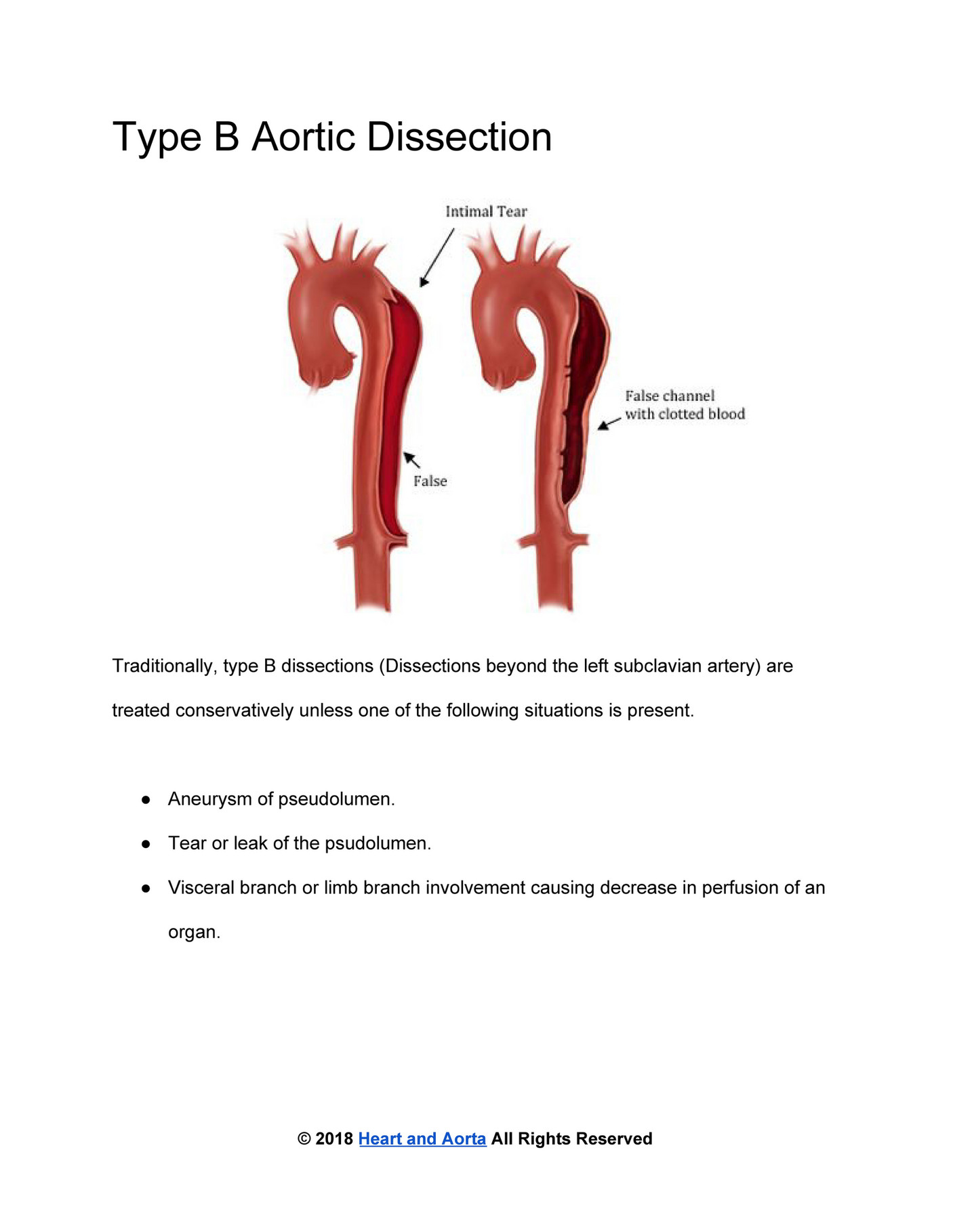 Heart And Aorta - Type B Aortic Dissection - Page 1 - Created With ...